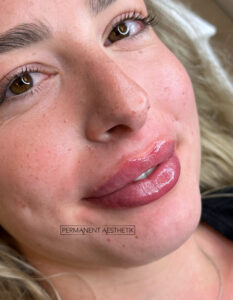 Permanent Aesthetik Lippenunterspritzung